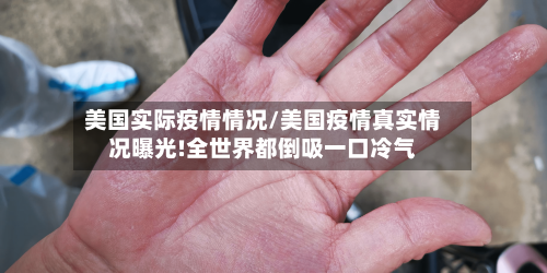 美国实际疫情情况/美国疫情真实情况曝光!全世界都倒吸一口冷气-第2张图片