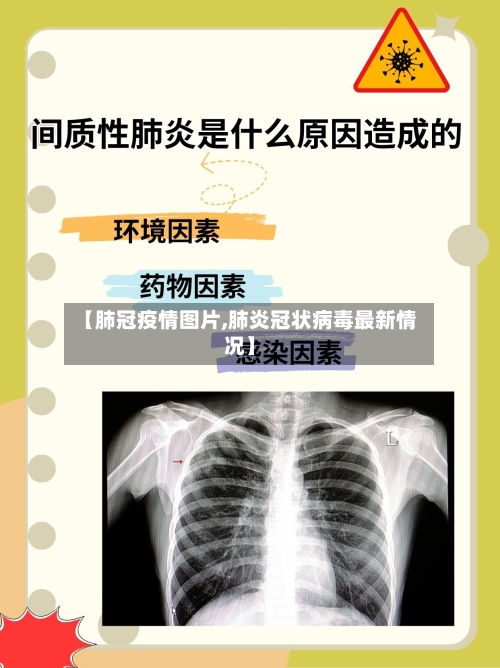 【肺冠疫情图片,肺炎冠状病毒最新情况】