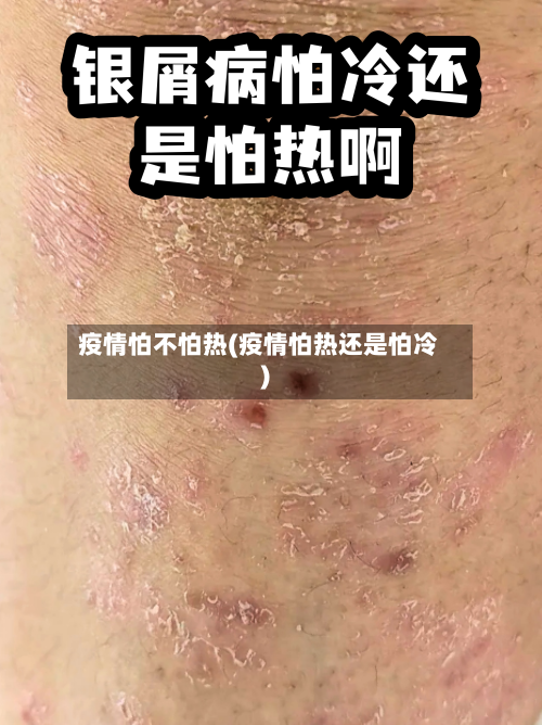 疫情怕不怕热(疫情怕热还是怕冷)-第2张图片